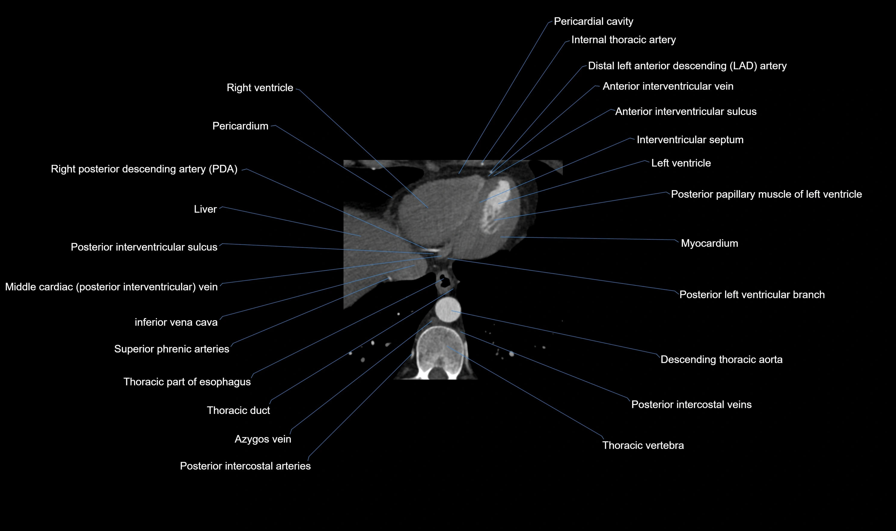 CT heart (coronary angiogram) axial view cross sectional anatomy labelled radiology image-00061.webp